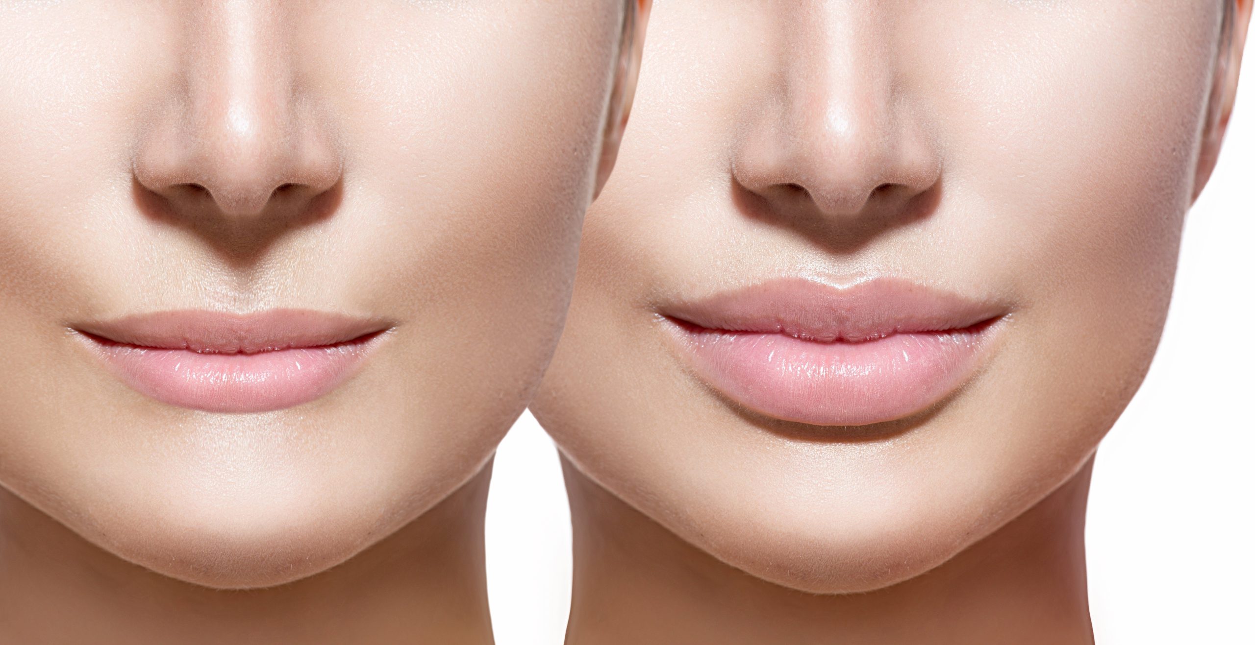 Lips Injections